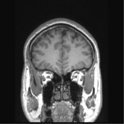 Cerebral arteriovenous malformation (Radiopaedia 39259-41506 Coronal T1 72).png