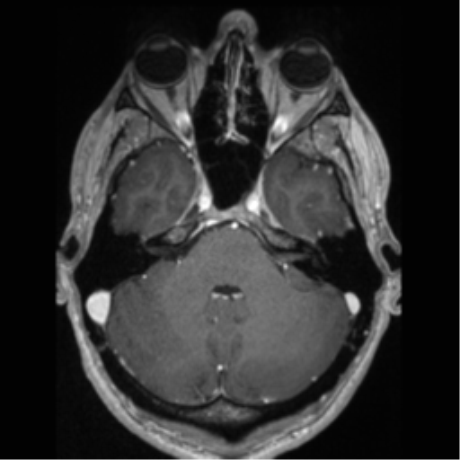 Cerebral arteriovenous malformation (Radiopaedia 55798-62372 Axial T1 C+ 19).png