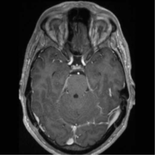 Cerebral arteriovenous malformation (Radiopaedia 55798-62372 Axial T1 C+ 26).png