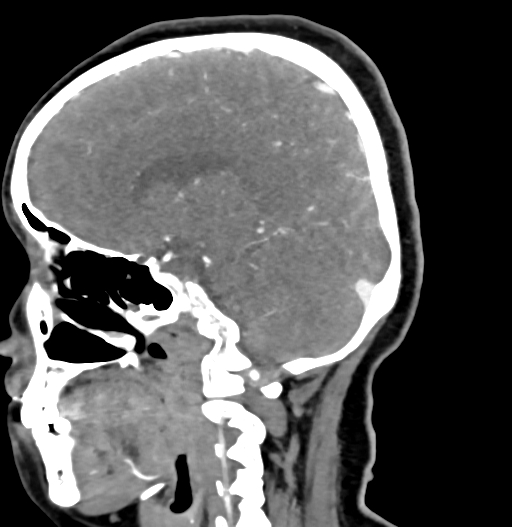 Cerebral arteriovenous malformation (Radiopaedia 73830-84645 D 40).jpg