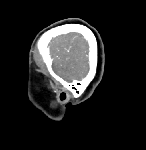 Cerebral arteriovenous malformation (Radiopaedia 73830-84645 D 9).jpg
