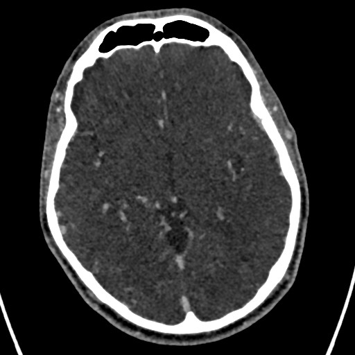 Cerebral arteriovenous malformation (Radiopaedia 78188-90746 Axial C+ delayed 82).jpg