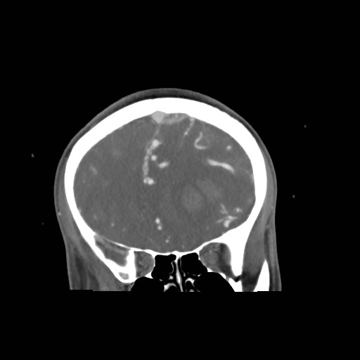 File:Cerebral arteriovenous malformation (Radiopaedia 79677-92888 B 9).jpg
