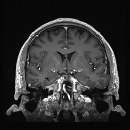 Cerebral arteriovenous malformation (Radiopaedia 84015-99245 Coronal T1 C+ 72).jpg