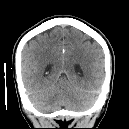 Cerebral arteriovenous malformation (Spetzler-Martin grade 2) (Radiopaedia 41262-44076 Coronal non-contrast 47).png