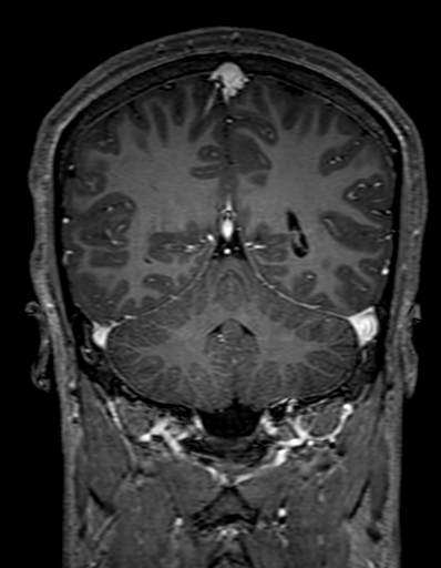 Cerebral arteriovenous malformation at posterior body of corpus callosum (Radiopaedia 74111-84925 K 263).jpg