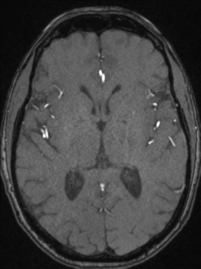 Cerebral arteriovenous malformation with hemorrhage (Radiopaedia 34422-35737 Axial MRA 43).png