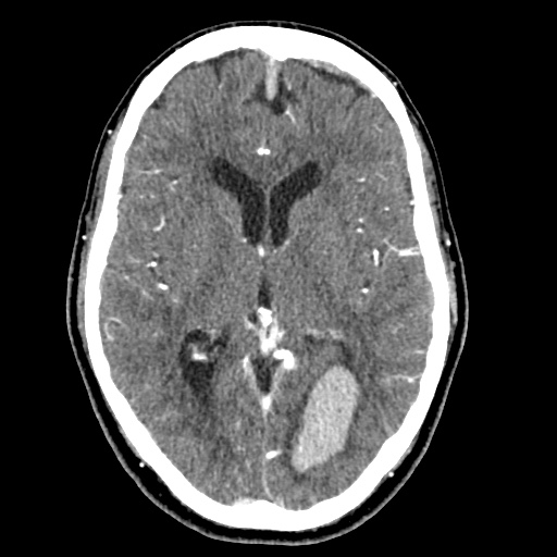 File:Cerebral arteriovenous malformation with lobar hemorrhage (Radiopaedia 35598-57216 A 31).jpg