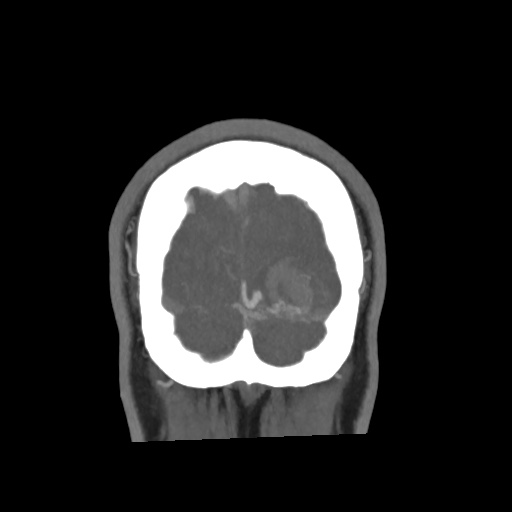 Cerebral arteriovenous malformation with lobar hemorrhage (Radiopaedia 35598-57216 C 86).jpg