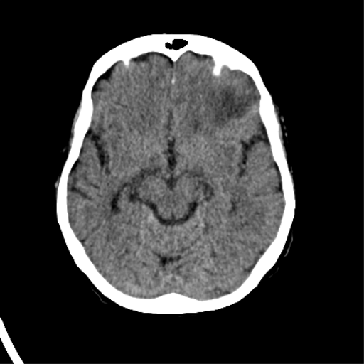 File:Cerebral arteriovenous malformation with lobar hemorrhage (Radiopaedia 44725-48510 Axial non-contrast 19).png