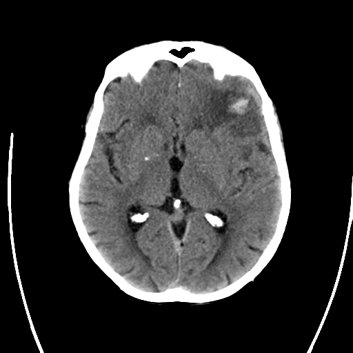 File:Cerebral arteriovenous malformation with lobar hemorrhage (Radiopaedia 44725-48512 Axial non-contrast 19).png