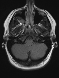 File:Cerebral cavernoma and development venous anomaly (Radiopaedia 37603-39482 Axial FLAIR 4).png