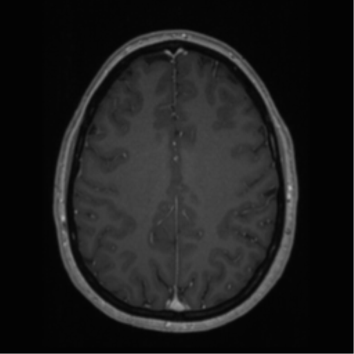 Cerebral cavernoma and development venous anomaly (Radiopaedia 37603-39482 Axial T1 C+ 52).png