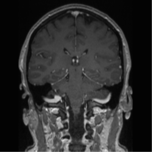 Cerebral cavernoma and development venous anomaly (Radiopaedia 37603-39482 Coronal T1 C+ 41).png
