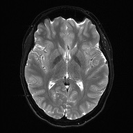 File:Cerebral cavernous venous malformation (Radiopaedia 70008-80021 Axial DWI 16).jpg
