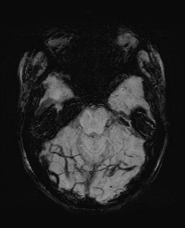 Cerebral cavernous venous malformation (Radiopaedia 70008-80021 Axial SWI 21).jpg