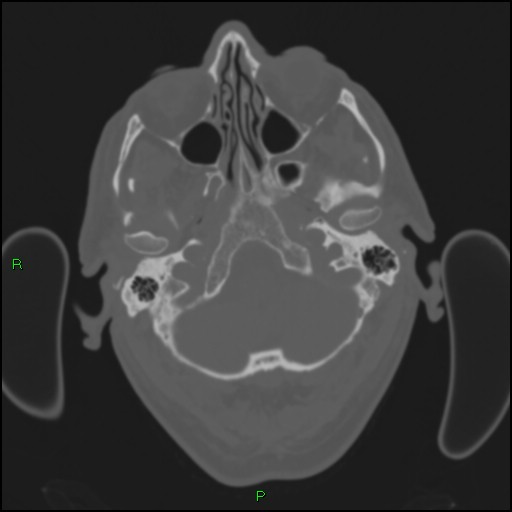Cerebral contusions (Radiopaedia 33868-35039 Axial bone window 25).jpg