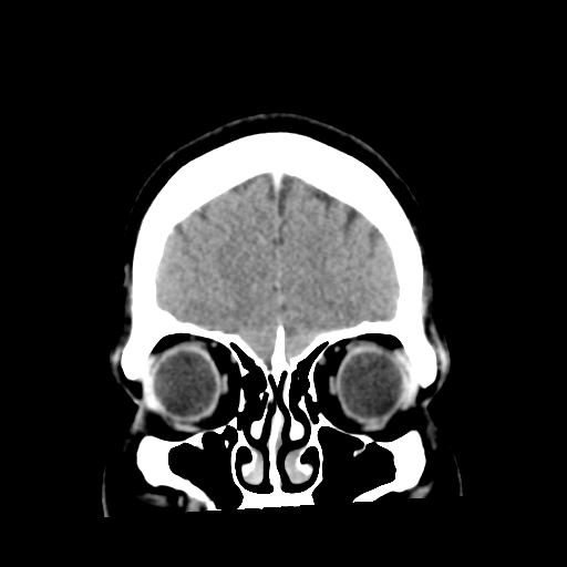 Cerebral hemorrhage secondary to arteriovenous malformation (Radiopaedia 33497-34561 C 11).png