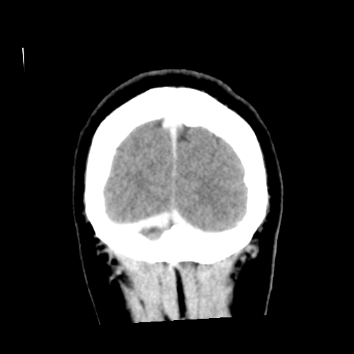 Cerebral hemorrhage secondary to arteriovenous malformation (Radiopaedia 33497-34561 C 61).png