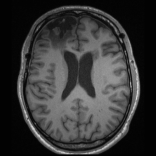 File:Cerebral hemorrhagic contusions- temporal evolution (Radiopaedia 40224-42757 Axial T1 47).png
