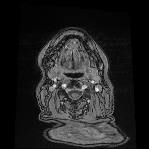 Cerebral metastases - melanoma (Radiopaedia 80972-94522 Axial T1 C+ 1).jpg