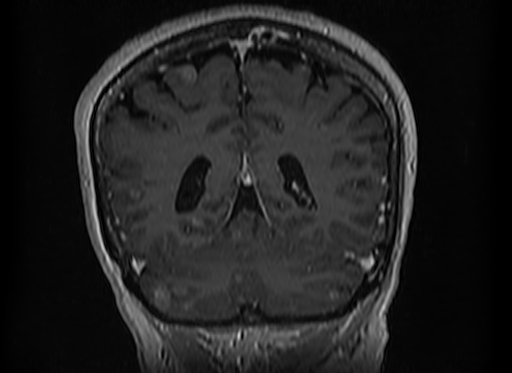 Cerebral metastases from lung cancer with amyloid angiopathy and cerebellopontine angle meningioma (Radiopaedia 74306-85191 Coronal T1 C+ 44).jpg