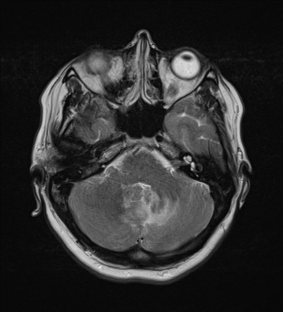 File:Cerebral metastases mimicking abscesses (Radiopaedia 45841-50131 Axial T2 8).png
