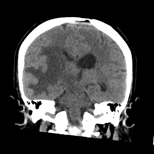Cerebral metastasis to basal ganglia (Radiopaedia 81568-95412 Coronal non-contrast 41).png
