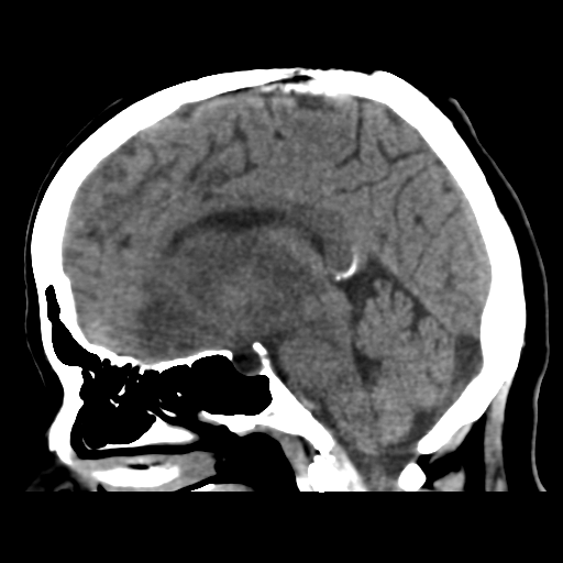 File:Cerebral metastasis to basal ganglia (Radiopaedia 81568-95412 E 31).png