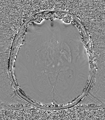 Cerebral metastasis to basal ganglia (Radiopaedia 81568-95413 Axial SWI phase 39).png