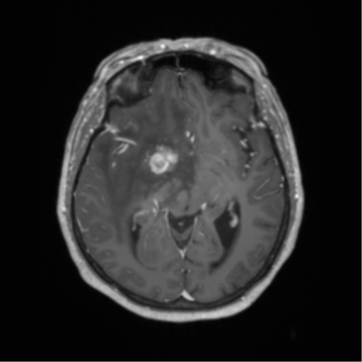 Cerebral metastasis to basal ganglia (Radiopaedia 81568-95413 Axial T1 C+ 32).png