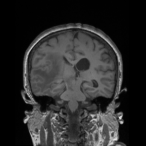 Cerebral metastasis to basal ganglia (Radiopaedia 81568-95413 Coronal T1 19).png