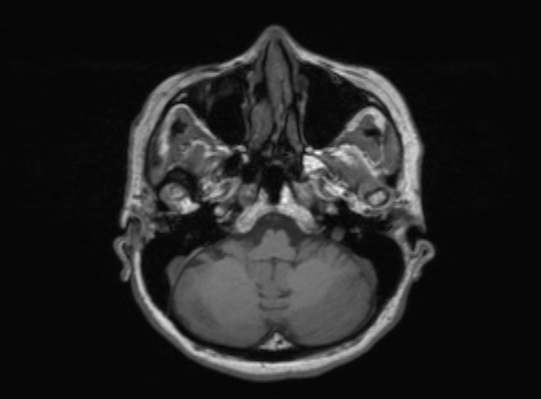Cerebral ring enhancing lesions - cerebral metastases (Radiopaedia 44922-48817 Axial T1 314).jpg