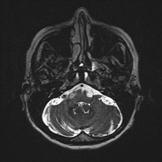 Cerebral ring enhancing lesions - cerebral metastases (Radiopaedia 44922-48817 F 22).jpg
