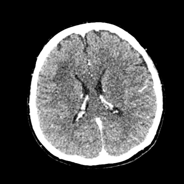 Cerebral ring enhancing lesions - cerebral metastases (Radiopaedia 44922-48818 B 172).jpg