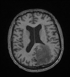 Cerebral toxoplasmosis (Radiopaedia 43956-47461 Axial T1 46).jpg