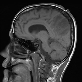File:Cerebral toxoplasmosis (Radiopaedia 43956-47461 Sagittal T1 12).jpg