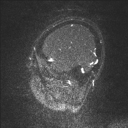 Cerebral tuberculosis with dural sinus invasion (Radiopaedia 60353-68090 Sagittal MRV 133).jpg