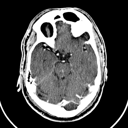 File:Cerebral venous angioma (Radiopaedia 69959-79977 B 24).jpg