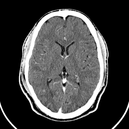 File:Cerebral venous angioma (Radiopaedia 69959-79977 B 48).jpg