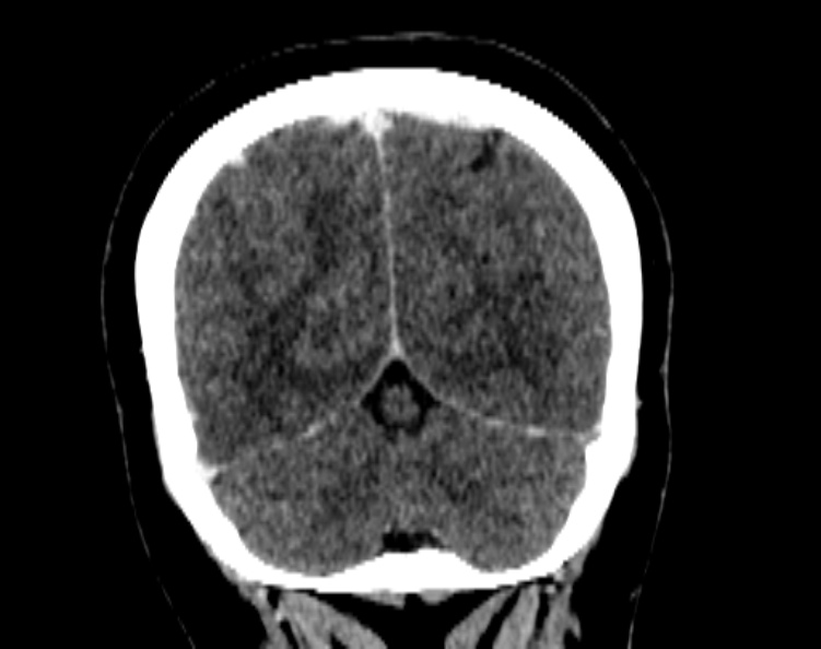 Cerebral venous hemorrhagic infarct from venous sinus thrombosis (Radiopaedia 55433-61883 Coronal C+ delayed 49).jpg