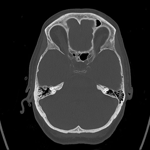 Cerebral venous infarction with hemorrhage (Radiopaedia 65343-74381 Axial bone window 38).jpg