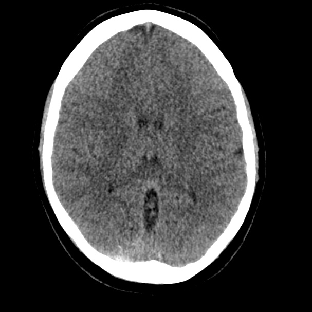 Cerebral venous sinus thrombosis (Radiopaedia 59224-66551 Axial non-contrast 20).jpg