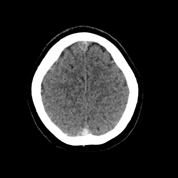 Cerebral venous sinus thrombosis (Radiopaedia 59224-66551 Axial non-contrast 40).jpg