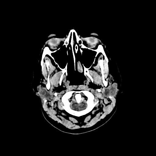 Cerebral venous throbmosis - hemorrhagic venous infarction (Radiopaedia 87318-103613 Axial non-contrast 1).jpg