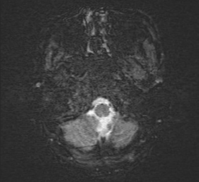 Cerebral venous thrombosis (Radiopaedia 71207-81504 Axial SWI 2).jpg