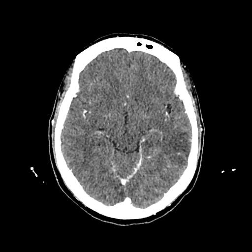 Cerebral venous thrombosis with venous hemorrhagic infarct (Radiopaedia 90354-107660 Axial with contrast 71).jpg