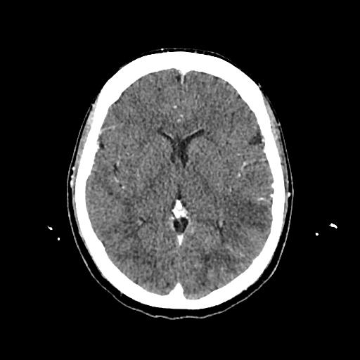 Cerebral venous thrombosis with venous hemorrhagic infarct (Radiopaedia 90354-107660 Axial with contrast 86).jpg