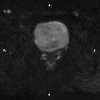 Cervical adenocarcinoma (Radiopaedia 65011-73985 Axial DWI 29).jpg