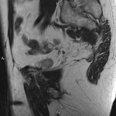 File:Cervical adenocarcinoma (Radiopaedia 65011-73985 Sagittal T2 6).jpg